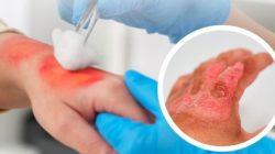 Jika mengalami Luka Bakar, Pertolongan Pertama yang Harus Diketahui