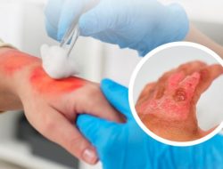 Jika mengalami Luka Bakar, Pertolongan Pertama yang Harus Diketahui