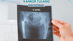 Hari Kanker Tulang Nasional RSUD Pandega Pangandaran Ingatkan Bahaya Kanker Tulang